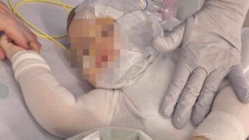 9-month-old-baby-attacked-with-hot-coffee-could-require-skin-grafts-after-second-surgery-but-is-expected-to-heal