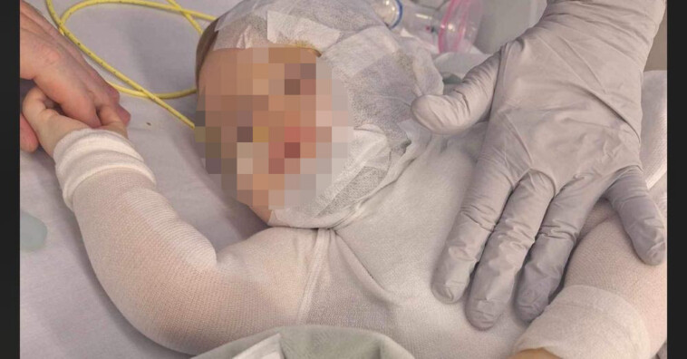 9-month-old-baby-attacked-with-hot-coffee-could-require-skin-grafts-after-second-surgery-but-is-expected-to-heal