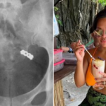 woman-accidentally-swallows-wedding-ring-while-taking-vitamins,-x-ray-shows