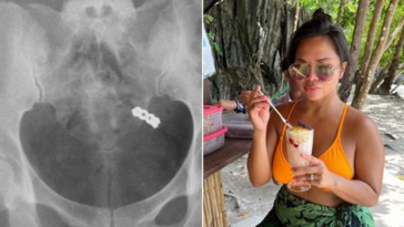 woman-accidentally-swallows-wedding-ring-while-taking-vitamins,-x-ray-shows