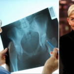 ellen-degeneres-has-osteoporosis:-here’s-what-to-know-about-the-painful-bone-condition