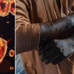 first-known-case-of-rare-mpox-strain-confirmed-in-united-states