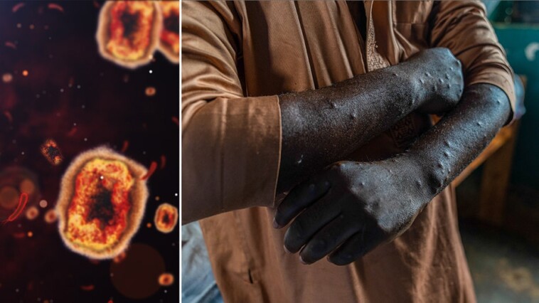 first-known-case-of-rare-mpox-strain-confirmed-in-united-states