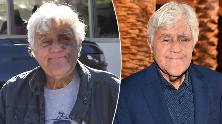 jay-leno-‘feeling-good’-despite-suffering-bruised-face-from-fall