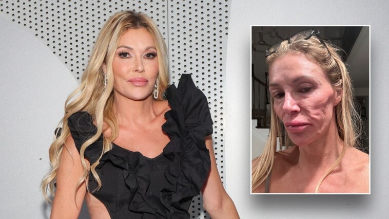 brandi-glanville-spending-‘all-of-my-money’-looking-for-answers-to-mystery-illness-that-left-her-disfigured