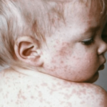 several-hospitalized-as-measles-outbreak-hits-children-in-texas