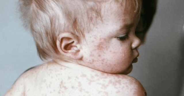 several-hospitalized-as-measles-outbreak-hits-children-in-texas