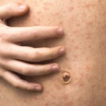 measles-outbreak-continues-in-texas,-cases-double:-investigation-underway