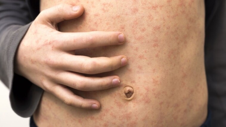 measles-outbreak-continues-in-texas,-cases-double:-investigation-underway