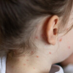 video:-measles-outbreak-rages-in-texas-with-48-cases-identified