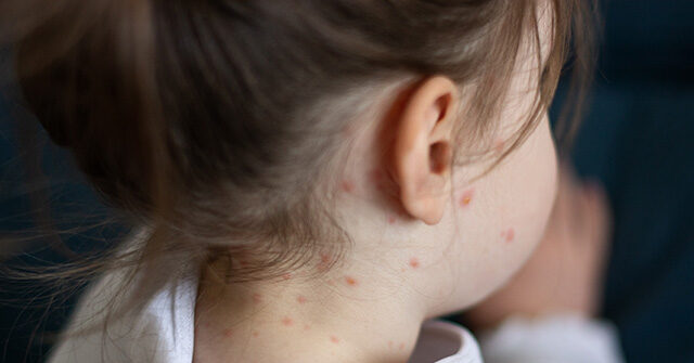 video:-measles-outbreak-rages-in-texas-with-48-cases-identified