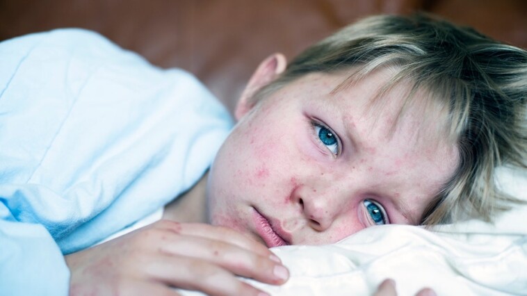 measles-outbreak-continues-to-worsen-among-kids-in-this-us-state