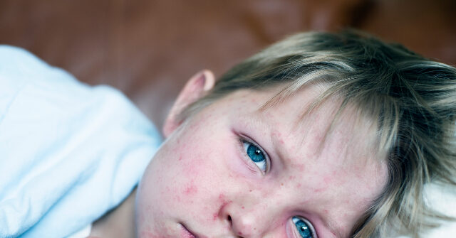 measles-cases-reported-in-kentucky,-new-jersey-as-texas-battles-outbreak