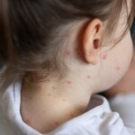 measles-cases-continue-to-spread-in-multiple-states-following-child’s-death