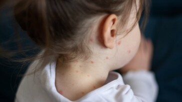 measles-cases-continue-to-spread-in-multiple-states-following-child’s-death