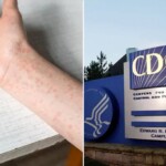 texas-measles-outbreak-swells-to-561-cases,-cdc-sends-more-help