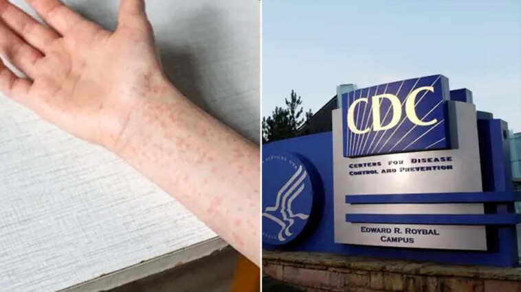 texas-measles-outbreak-swells-to-561-cases,-cdc-sends-more-help