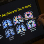 fda-approves-blood-test-that-can-help-diagnose-alzheimer’s-disease