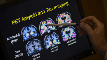 fda-approves-blood-test-that-can-help-diagnose-alzheimer’s-disease