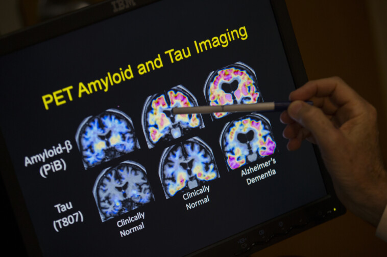 fda-approves-blood-test-that-can-help-diagnose-alzheimer’s-disease