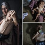 viral-images-of-starving-gaza-boy-don’t-tell-the-whole-story-because-he-suffers-from-genetic-disorders,-critics-say