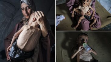 viral-images-of-starving-gaza-boy-don’t-tell-the-whole-story-because-he-suffers-from-genetic-disorders,-critics-say
