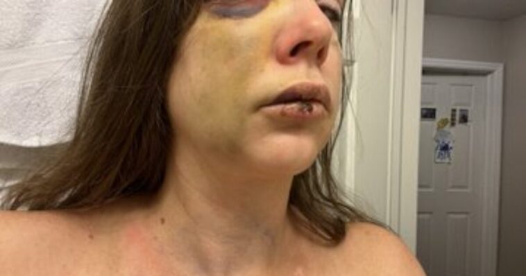 cincinnati-mob-violence-victim-holly-breaks-her-silence,-reveals-she-is-suffering-“very-bad”-brain-trauma-(video)