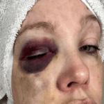 watch:-cincinnati-brawl-victim-reveals-she-suffered-‘bad-brain-trauma’