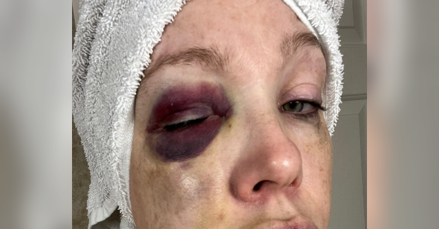 watch:-cincinnati-brawl-victim-reveals-she-suffered-‘bad-brain-trauma’