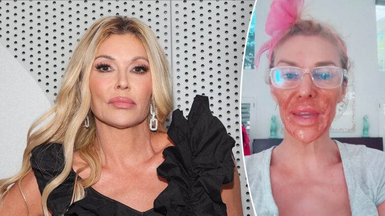 brandi-glanville-suffers-severe-chemical-burns-on-her-face-while-trying-to-self-treat-mystery-illness