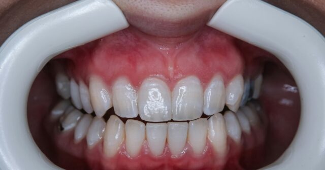 video-—-police:-florida-woman-posing-as-veneer-tech-used-‘crazy-glue’-on-clients’-teeth