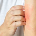 a-promising-new-treatment-for-the-84-million-americans-suffering-from-skin-conditions