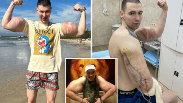 russian-‘popeye’-who-injected-his-biceps-to-grow-freakishly-big-could-now-lose-both-arms-to-gruesome-infection