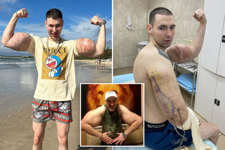 russian-‘popeye’-who-injected-his-biceps-to-grow-freakishly-big-could-now-lose-both-arms-to-gruesome-infection