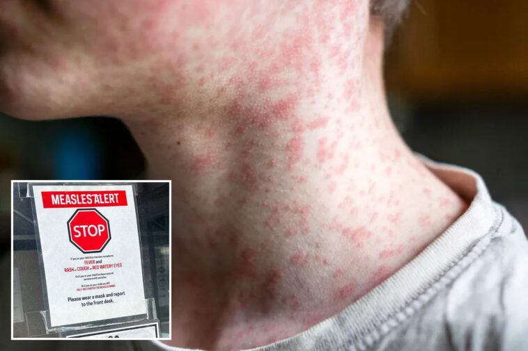 measles-outbreak-explodes-in-south-carolina;-multiple-people-hospitalized-as-cases-surpass-200