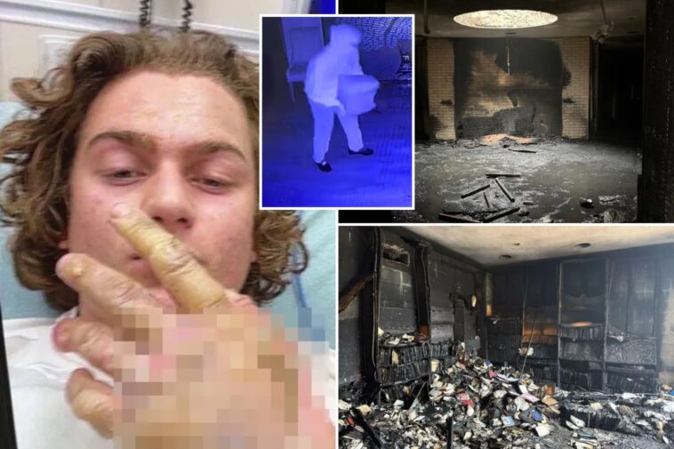 teen-accused-of-torching-mississippi-synagogue-posted-gruesome-selfie-of-severe-burns-hours-after-attack