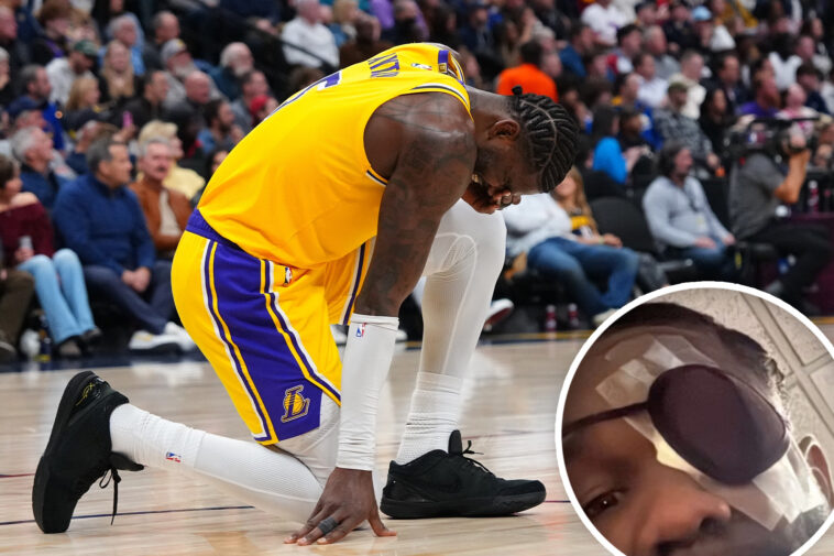 lakers-coach-jj-redick-concerned-over-star-player’s-eye-injury:-‘he-looks-like-a-pirate’