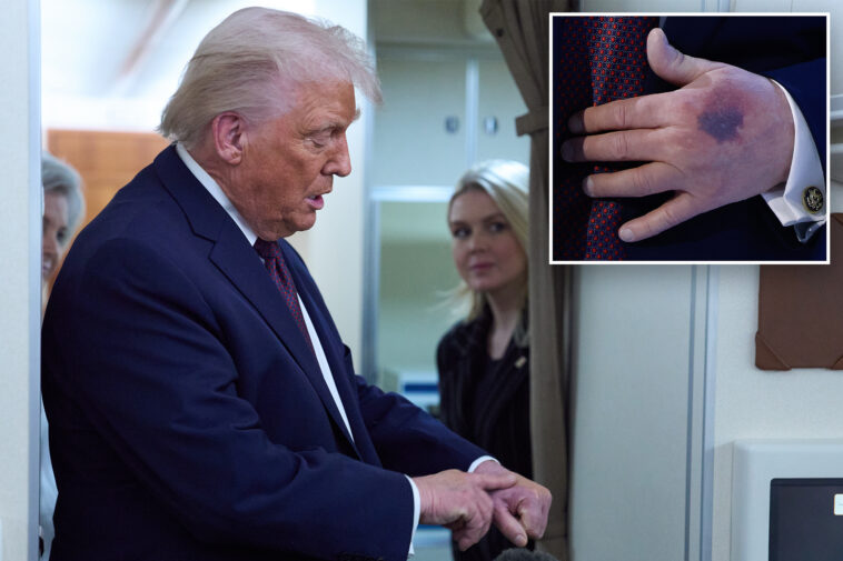 trump-reveals-how-he-got-large-bruise-on-his-hand-as-he-trashes-health-conspiracies