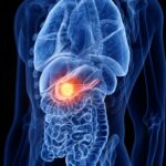 ‘triple-threat’-breakthrough:-new-therapy-eradicates-pancreatic-tumors-in-preclinical-study