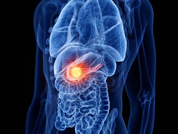 ‘triple-threat’-breakthrough:-new-therapy-eradicates-pancreatic-tumors-in-preclinical-study