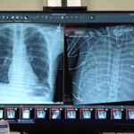 surgeons-keep-man-alive-without-lungs,-paving-new-path-to-transplant