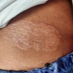 minnesota-officials-forced-to-sound-the-alarms-over-fungal-std-outbreak