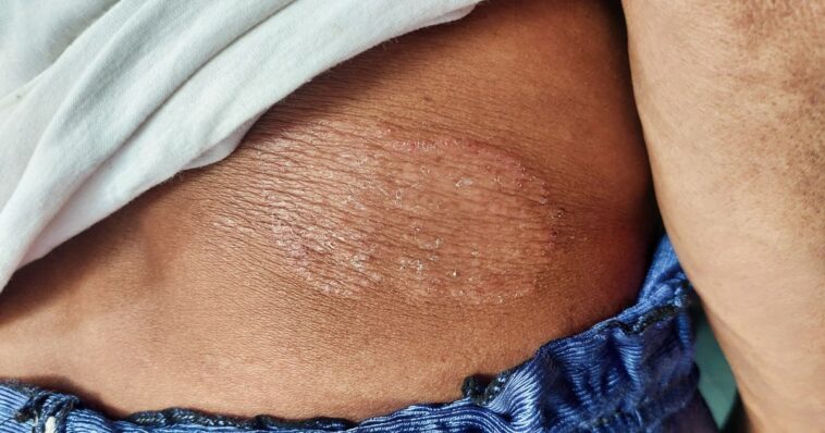 minnesota-officials-forced-to-sound-the-alarms-over-fungal-std-outbreak