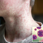 fourth-measles-case-confirmed-in-la-county-as-community-urged-to-take-precautions