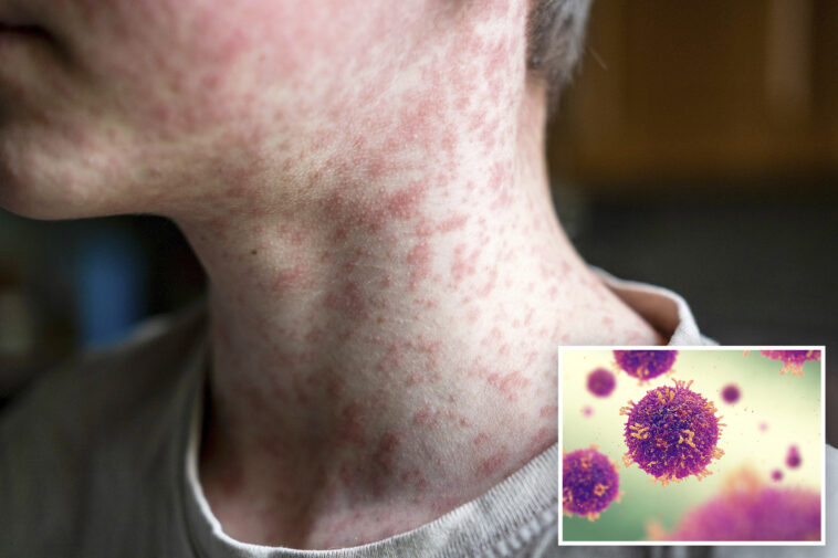 fourth-measles-case-confirmed-in-la-county-as-community-urged-to-take-precautions