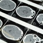 china’s-ultrasound-brain-tech-race-heats-up