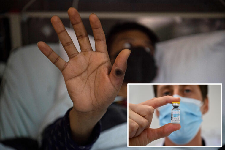 first-known-case-of-severe-mpox-virus-strain-detected-in-nyc