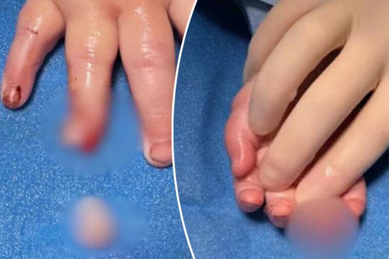 baby’s-finger-allegedly-severed-at-day-care-center