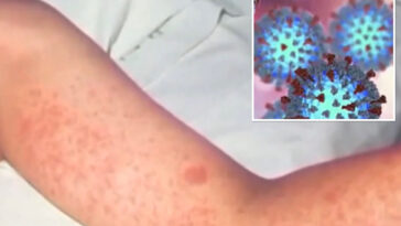 world’s-most-contagious-disease-continues-to-spread-in-california-as-more-clusters-form