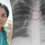 woman-discovers-missing-nose-ring-traveled-to-her-lungs,-causing-month-long-cough